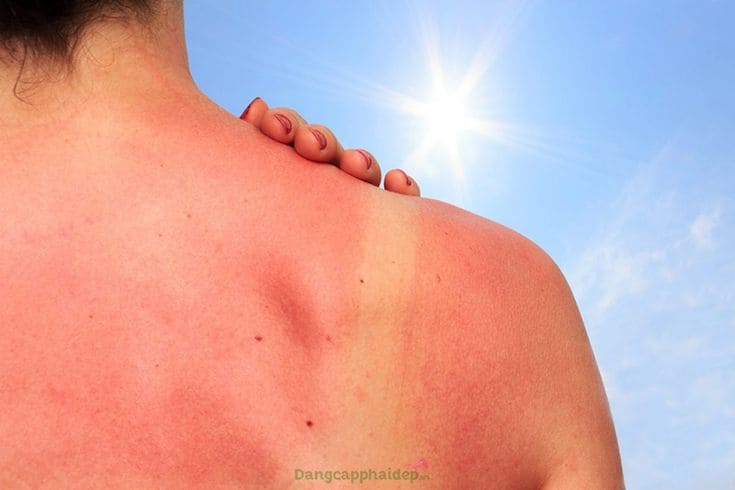 Da Nhạy Cảm Như Mình Và Nỗi Sợ Ánh Nắng Biển